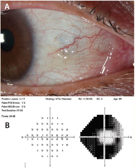 Increased Episcleral Venous Pressure As An Etiology Of Glaucoma