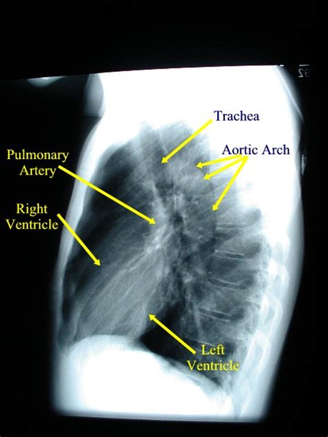 We've labeled and outlined the main visible anatomical structures such as lungs. Chest X-ray