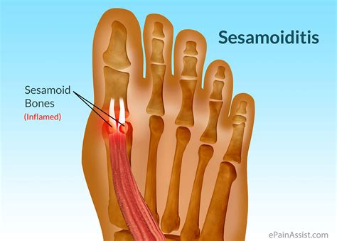 Symptoms that never occur with posterior tibialis tendinopathy: Sesamoiditis: Why the ball of your foot is killing you ...