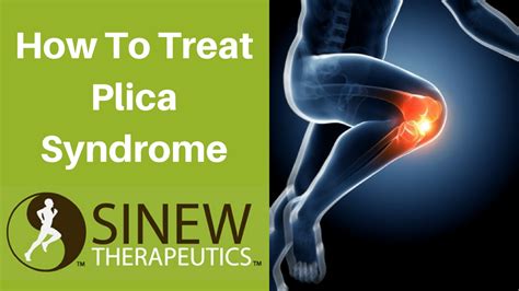 How To Treat Plica Syndrome And Speed Recovery Youtube