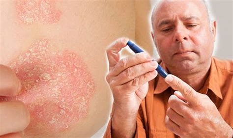 New Study Finds 47 Types Of Skin Diseases Associated With Type 2