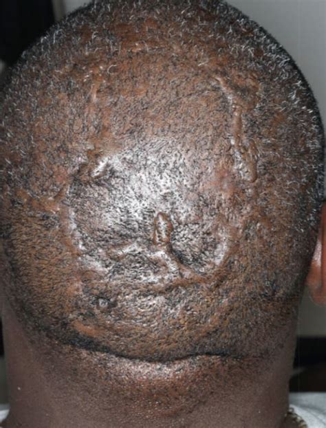 Acd A Z Of Skin Dissecting Cellulitis Of The Scalp