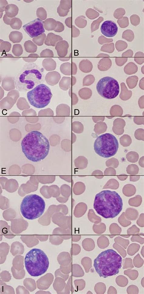 Medical Laboratory And Biomedical Science Lymphocytes Variation