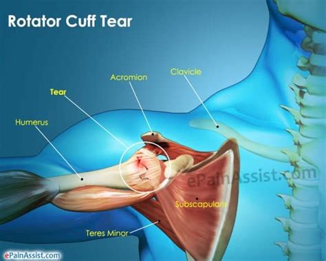 The treatment for a rotator cuff repair often depends on the tear's severity, and how much it is affecting the individual. The 5 Most Common Injuries of Serious Lifters
