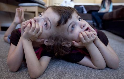 Through Her Sisters Eyes Conjoined Bc Twins Were Extraordinary From