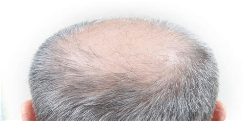Bald Spot On Crown Asmed Hair Transplant