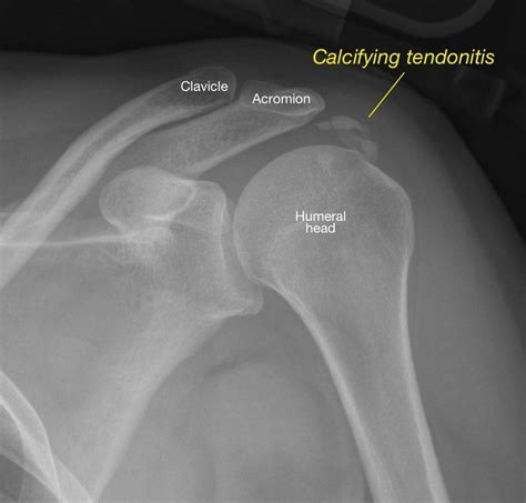 Calcific Tendonitis Of The Shoulder Orthopedic Center For Sports Medicine Sports Medicine