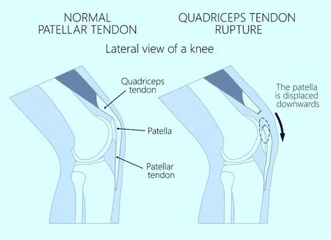 Quadriceps Tendon Rupture Repair Surgery Orthopedic Knee Surgeon