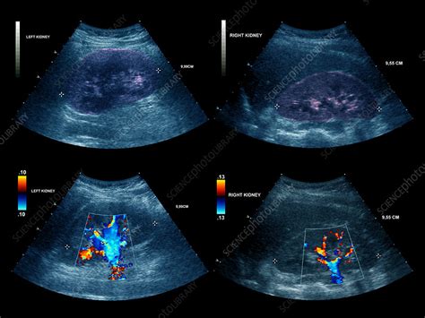 Healthy Kidneys Ultrasound Scan Stock Image P5500254 Science