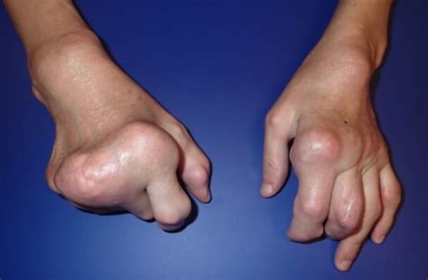 Deformities Of The Hand Hand Surgery Associates