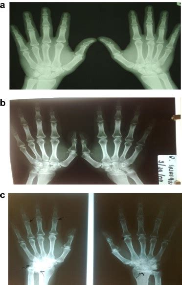 Left Soft Tissue Swelling On The Proximal Interphalan