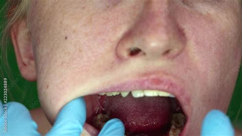 A Woman With Stomatitis On Her Cheek Consequences After The Removal Of