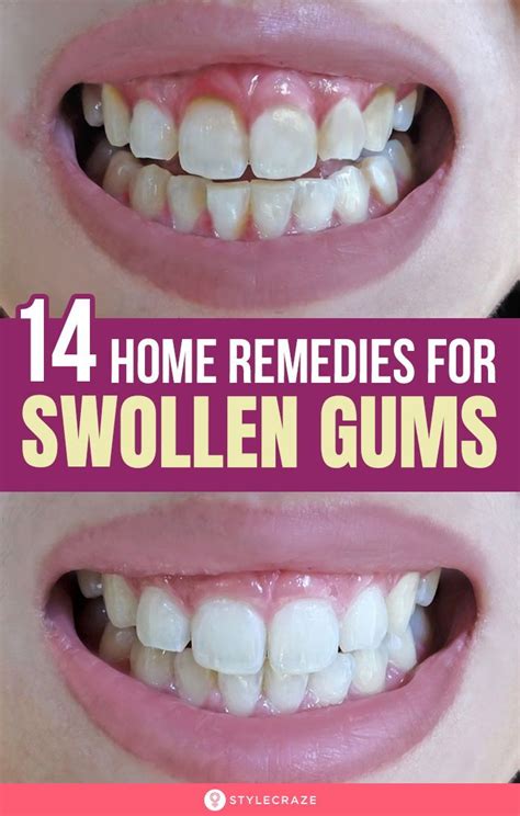 14 Home Remedies For Swollen Gums And Prevention Tips Artofit
