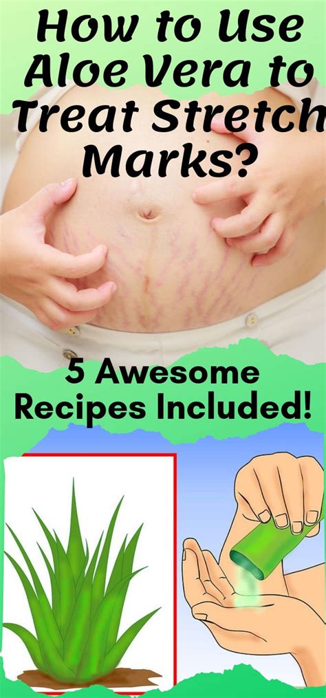 How To Use Aloe Vera To Treat Stretch Marks Awesome Recipes Included