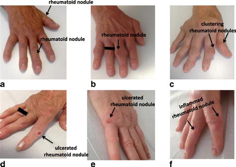 Accelerated Subcutaneous Nodulosis In Patients With Rheumatoid