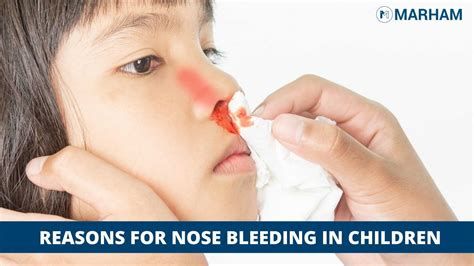 Nose Bleed Causes Treatment And More Ubicaciondepersonascdmxgobmx