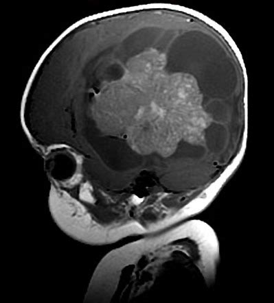Pediatric Choroid Plexus Carcinoma Pediatric Radiology Reference Hot Sex Picture