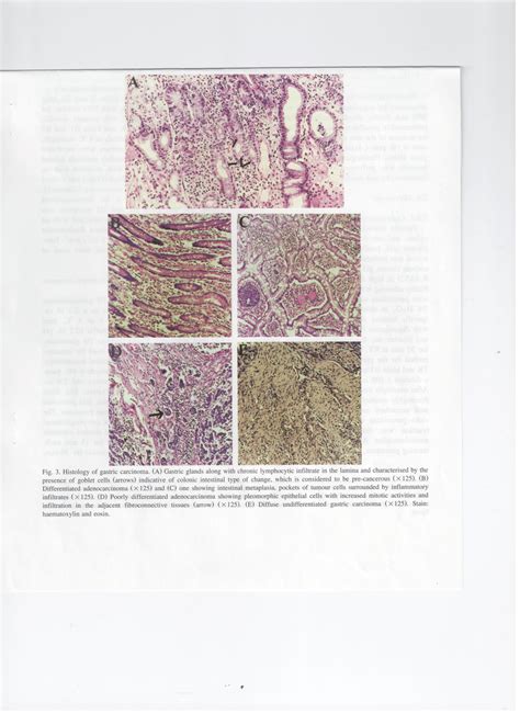 Pdf Histology Of Gastric Carcinoma