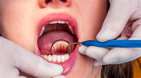 Every once in a while, we'd visit our grandmother and she'd offer us free teeth cleanings at the dentist's office. The Importance of Dental Deep Cleaning | Balsall Common Dental