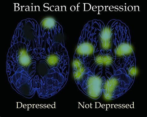 Depression And Bipolar Disorder Hubpages
