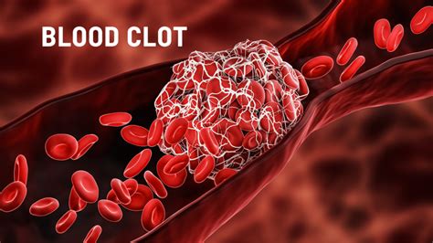Warning Signs Of A Blood Clot You Dont Want To Ignore Indianapolis
