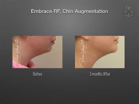 Embracerf Case 4838 New Orleans Premier Center For Aesthetics And Plastic Surgery