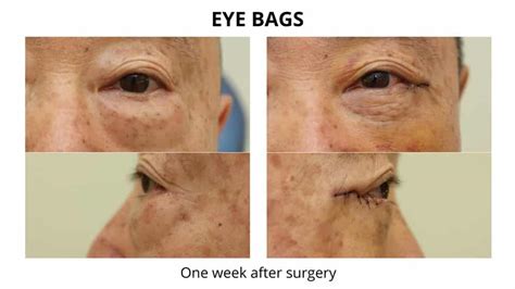 Before And After Oculoplastic Surgery Dr Anthony Maloof In Sydney