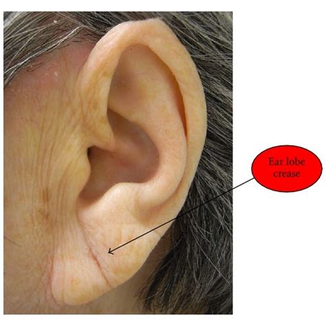 A Complete Ear Lobe Crease On The Left Side Of Ear Of A Female