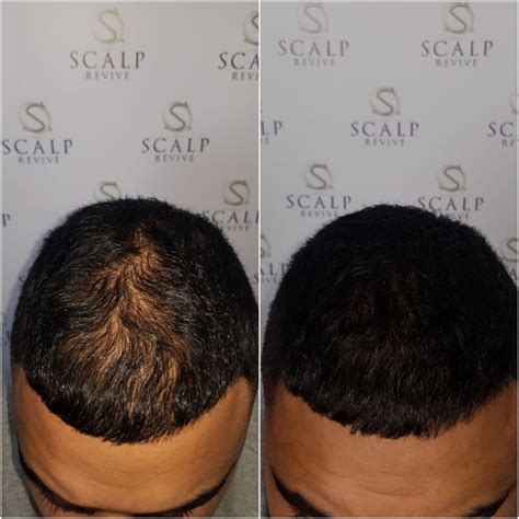 Scalp Micropigmentation Price How Do You Price A Switches