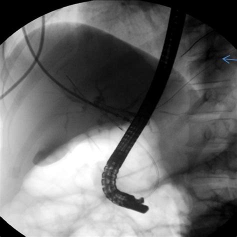 Plain computed tomography scan showing (A) Plastic common bile duct ...