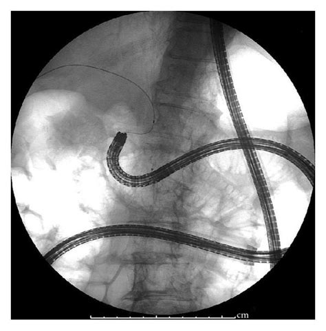 Enteroscope Assisted Ercp A X Ray Film Showed That An Enteroscope