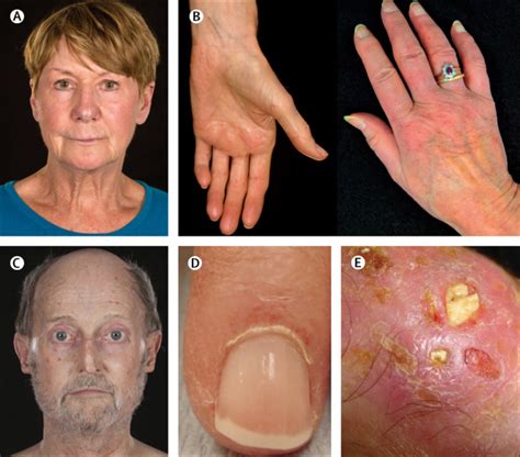 Systemic Sclerosis The Lancet