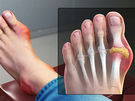 Gout In Big Toe How To Identify Causes And Treatment