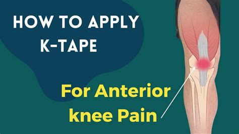 How To Apply Kinesiology Tape For Knee Pain Patella Femoral Syndrome