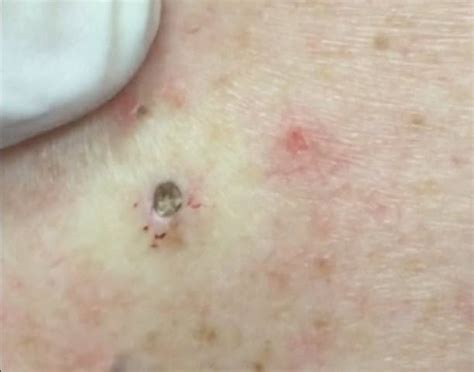 Watch This Dr Pimple Popper Huge Blackhead Unleashed