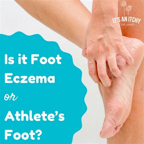 Is It Foot Eczema Or Something Else Its An Itchy Little World