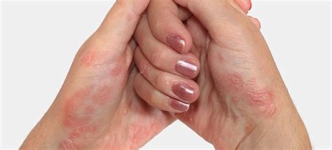 Psoriasis Treatment In South Miami Treat Dry Red And Itchy Skin