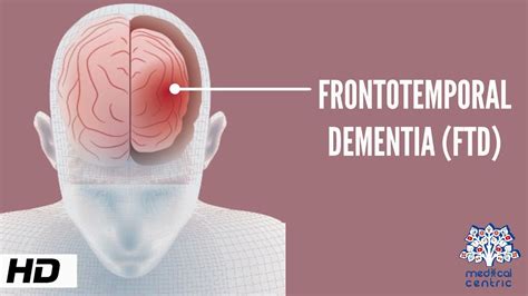Frontotemporal Dementia Causes Signs And Symptoms Diagnosis And