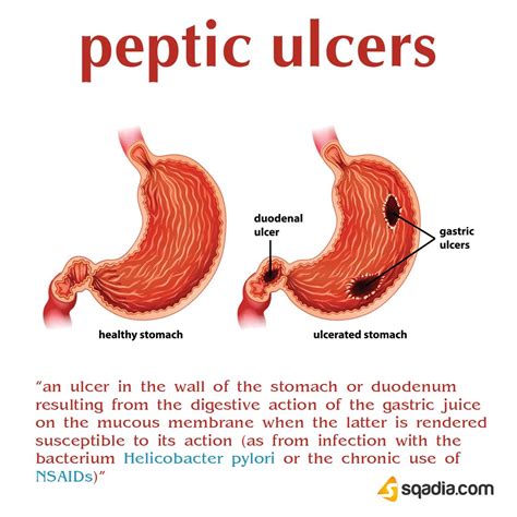 Peptic Ulcers Peptic Ulcer Medical Healthy Stomach