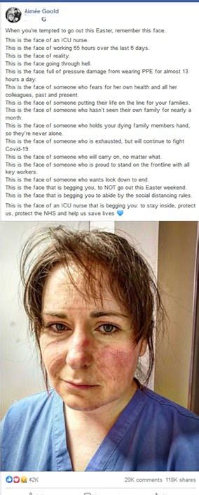 Intensive Care Nurse Posts Picture Of Her Exhausted Face Bruised By Wearing Protective Gear