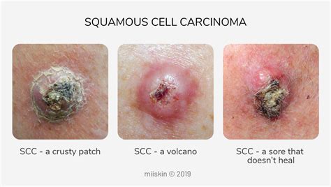 What Does Skin Cancer Look Like On Your Back Johnson Lefterim