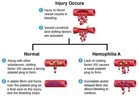 Sex Linkage In Haemophilia And Duchenne Muscular Dystrophy The A