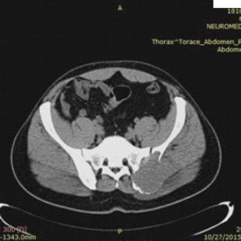 Male 27 Years Old Right Iliac Sacral Osteosarcoma A Positive