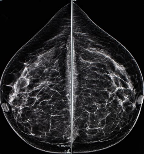 Mammogram Radio Imaging For Breast Cancer Diagnosis Odc