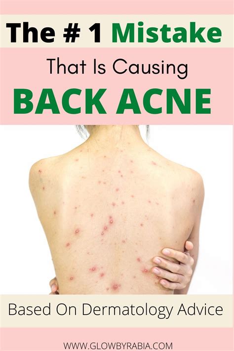 Everything You Need To Know About Treating Back Acne Artofit