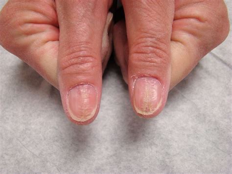 Thumb Nail Deformities In A Mature Woman