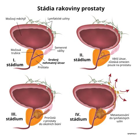 Rakovina prostaty příznaky a léčba