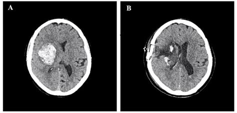 Patient 2 With Right Basal Ganglia Deep Brain Parenchymal Haematoma