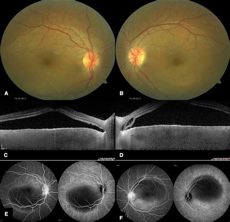 Bilateral Serous Retinal Detachment In The Right A And Left Eye B