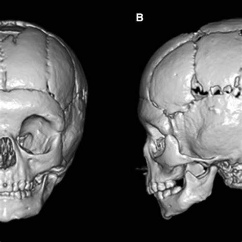 Three Dimensional Computed Tomography Imaging 6 Months Postoperative